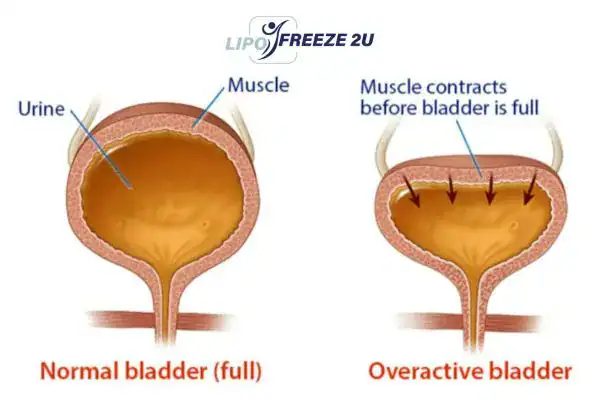 diagram of overactive bladder treatment Weybridge