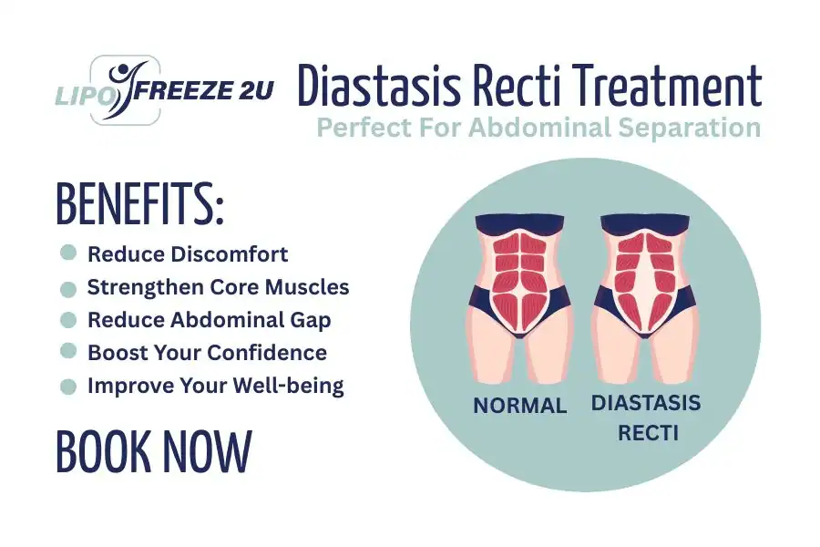 Benefits of body toning treatment Weybridge for Diastasis recti