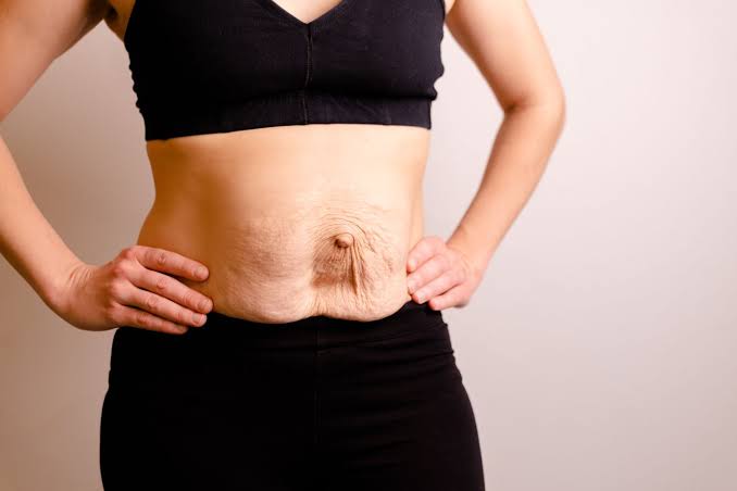 Is Surgery Really the Only Way to Repair Diastasis Recti Weybridge?