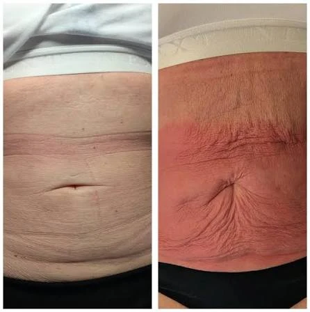 How Does RF Microneedling Improve Crepey, Thin and Uneven Skin Texture Weybridge?