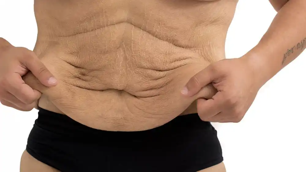 Why Does Weight Loss Medication Leave Some People With Loose or Sagging Skin Weybridge?